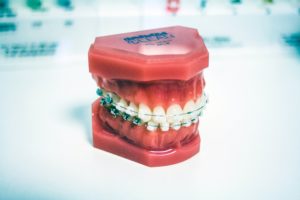 A mouth replica wearing wire dental braces